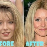 Kelly Ripa plastic surgery (18)