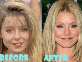 Kelly Ripa plastic surgery (18)