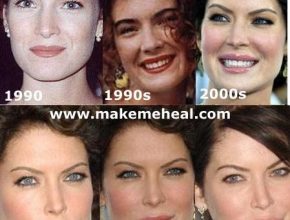 Lara Flynn Boyle after plastic surgery