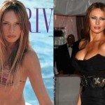 Melania Trump before and after breast augmentation (22)