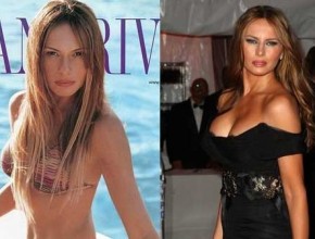 Melania Trump before and after breast augmentation (22)