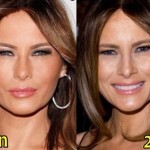 Melania Trump before and after plastic surgery (19)
