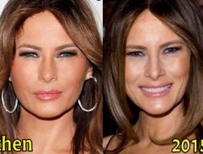 Melania Trump before and after plastic surgery (19)