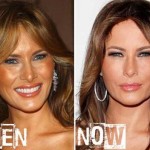 Melania Trump before and after plastic surgery (21)