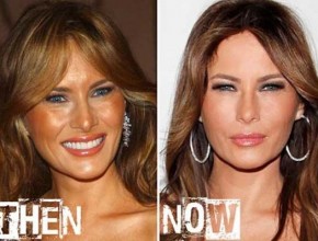 Melania Trump before and after plastic surgery (21)