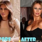 Melania Trump before and after plastic surgery (23)