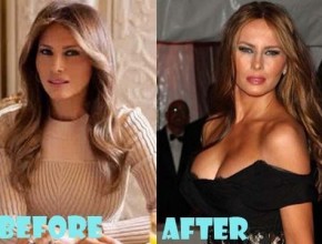 Melania Trump before and after plastic surgery (23)