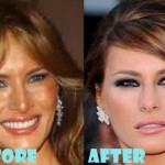 Melania Trump before and after plastic surgery (24)