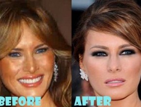 Melania Trump before and after plastic surgery (24)