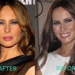 Melania Trump before and after plastic surger