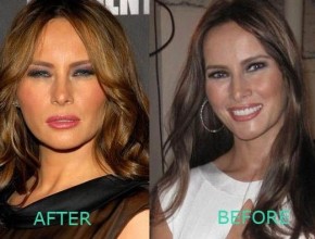 Melania Trump before and after plastic surger