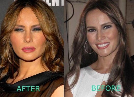 Melania Trump before and after plastic surger
