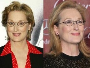 Meryl Streep before and after plastic surgery (13)