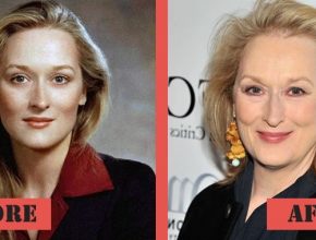 Meryl Streep before and after plastic surgery (18)