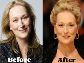 Meryl Streep before and after plastic surgery (22)