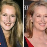 Meryl Streep before and after plastic surgery (7)