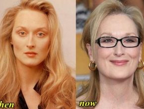 Meryl Streep before and after plastic surgery (9)