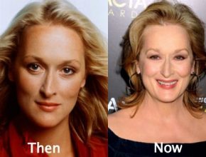 Meryl Streep plastic surgery (20)