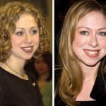 Chelsea Clinton before and after plastic surgery (11)