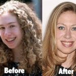 Chelsea Clinton before and after plastic surgery (15)