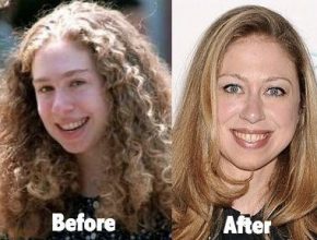 Chelsea Clinton before and after plastic surgery (15)