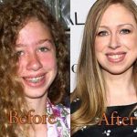 Chelsea Clinton before and after plastic surgery (19)