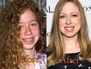 Chelsea Clinton before and after plastic surgery (19)