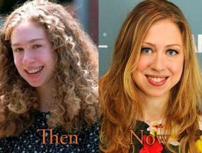 Chelsea Clinton before and after plastic surgery (20)