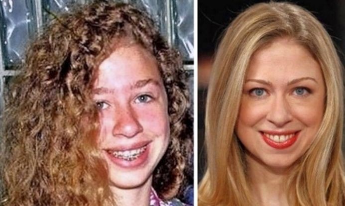 Chelsea Clinton before and after plastic surgery