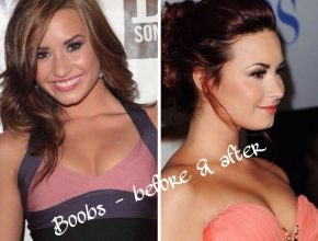 Demi Lovato before and after breast augmentation (29)