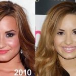 Demi Lovato before and after plastic surgery (9)
