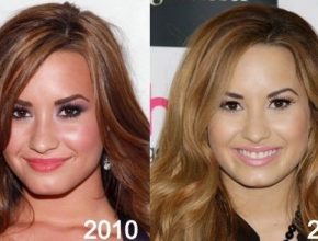 Demi Lovato before and after plastic surgery (9)