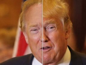 Donald Trump before and after using botox (16)