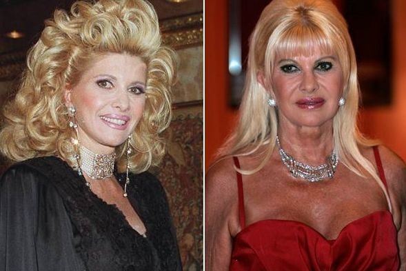 Ivana Trump before and after plastic surgery