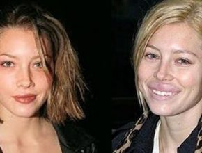 Jessica Biel before and after lip augmentation (34)