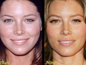 Jessica Biel before and after plastic surgery (6)