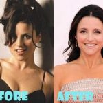 Julia Louis-Dreyfus before and after plastic surgery (16)