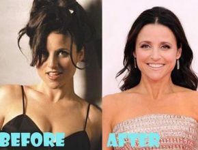 Julia Louis-Dreyfus before and after plastic surgery (16)