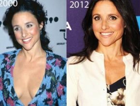 Julia Louis-Dreyfus before and after plastic surgery (19)