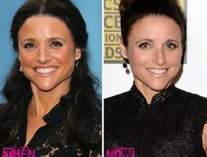 Julia Louis-Dreyfus before and after plastic surgery (20)
