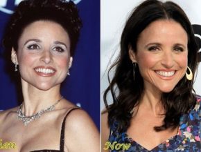 Julia Louis-Dreyfus before and after plastic surgery (21)