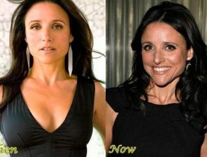 Julia Louis-Dreyfus before and after plastic surgery (22)