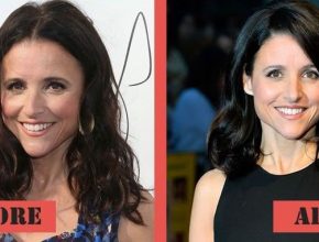 Julia Louis-Dreyfus before and after plastic surgery (24)