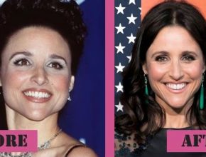 Julia Louis-Dreyfus before and after plastic surgery (26)