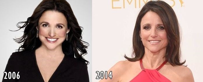 Julia Louis-Dreyfus before and after plastic surgery