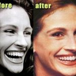 Julia Roberts before and after dental plastic surgery (36)