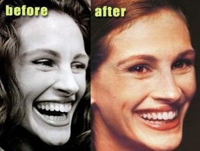 Julia Roberts before and after dental plastic surgery (36)