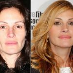 Julia Roberts before and after plastic surgery (14)