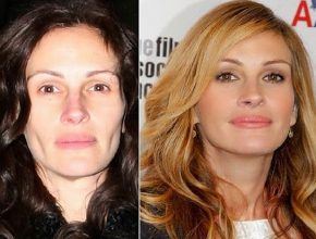 Julia Roberts before and after plastic surgery (14)
