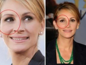 Julia Roberts eye lid plastic surgery (32)